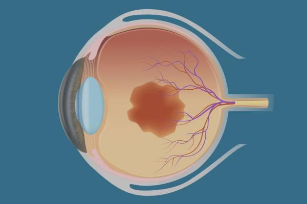OCHI CLINIC | 2D EYE SURGERY EXPLAINER