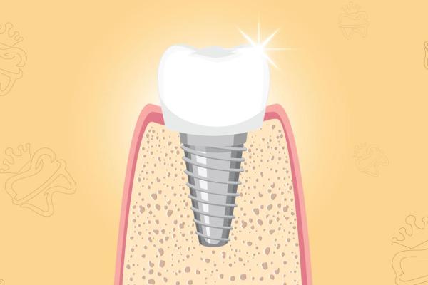 VENERA | 2D DENTAL IMPLANT EXPLAINER VIDEO